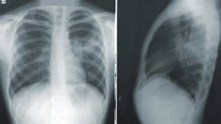 Pulmonary PANCE Review [upl. by Ahtoelc]