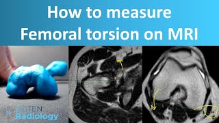 How to Measure Femoral Torsion on MRI [upl. by Lamprey793]