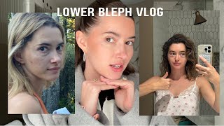 I got plastic surgery Lower blepharoplasty vlog [upl. by Orella]