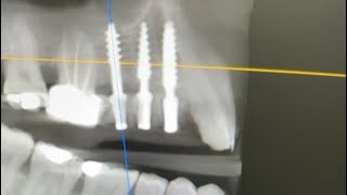 3 single piece dental implants for replacing upper premolarsamp molarspreamppost cbct analysis [upl. by Eirek]