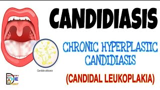 CANDIDIASIS  PRIMARY CHRONIC FORM  HYPERPLASTIC CANDIDIASIS OR CANDIDAL LEUKOPLAKIA [upl. by Suoivatnod546]