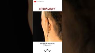 Ear reshaping surgery 👂  Otoplasty [upl. by Akcinat]