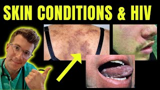 Doctor explains skin conditions associated with HIV  AIDS eg Kaposi sarcoma candida amp more [upl. by Itoc384]