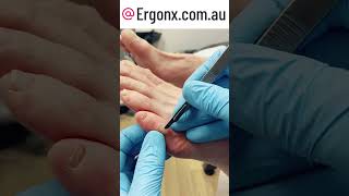 Painful corn on little toe removal by Australian podiatrist [upl. by Estus]