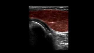 Musculoskeletal Ultrasound Elbow 2 anterior humeroulnar longitudinal scan [upl. by Dera]