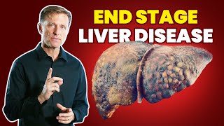 10 Signs of a Dying Liver End Stage Liver Disease [upl. by Volnay]