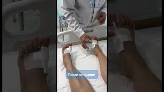 Лечение HALLUX VALGUS шишка на ногах вальгус плоскостопие здоровье здоровыйобразжизни хирург [upl. by Hsetim]