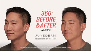 How to Instantly Improve Jawline Definition with JUVÉDERM® Filler  Mykol’s Before amp After [upl. by Drarehs]