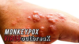 Mpox Virus Outbreak What You Need to Know [upl. by Gunter897]