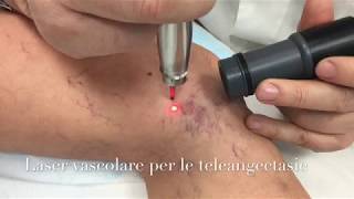 Laser vascolare per i capillari delle gambe [upl. by Danita837]