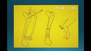 Allongement progressif des membres par clou centromédullaire [upl. by Salina847]