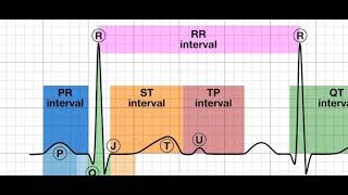 myocardial infarction stemi and nstemi [upl. by Enaols]