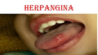 Herpangina [upl. by Henrique]