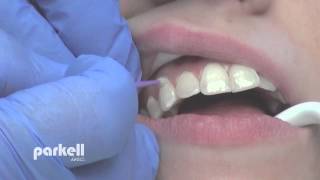 Desensitizing tooth surfaces using BrushampBond or PainFree F [upl. by Cordova]