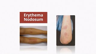 Erythema Nodosum  Causes amp Treatment [upl. by Esinahs]