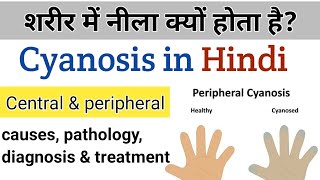 what is cyanosis  causes types amp treatment in Hindi [upl. by Sluiter]