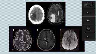 Neuroradiology meeting Pediatric brain tumors [upl. by Allerus824]