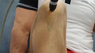 Osgood Schlatter treatment with shockwave [upl. by Haggai]