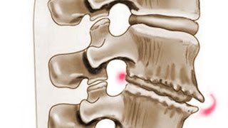 Osteoxondroz və onun müalicəsi  Остеохондроз Симптомы и лечение остеохондроза [upl. by Britteny390]