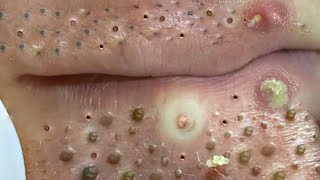 Big Cystic Acne Blackheads Extraction Blackheads amp Milia Whiteheads Removal Pimple Popping  203 [upl. by Yendic32]