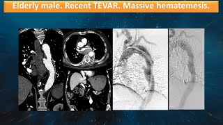 Elderly male Recent TEVAR Massive hematemesis [upl. by Amato]