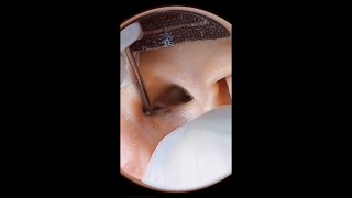 Blackheads Removal From EAR Blackheads Removal Videos 2023 [upl. by Camilo875]