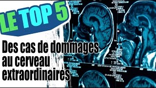 Le top 5 des cas de traumatisme au cerveau extraordinaires [upl. by Atinauj926]