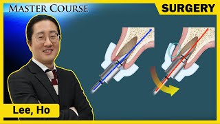 Master Course Season2  SURGERY OneGuide KIT for Maxillary Anterior Region [upl. by Legge788]