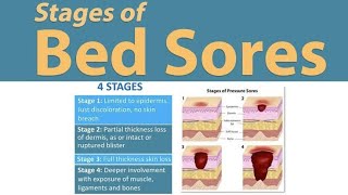 what is the Bed sore pressure sores ulcer Dr Health Officials [upl. by Moshe]