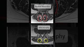 How to check Multifidus muscle in MRI [upl. by Creedon]