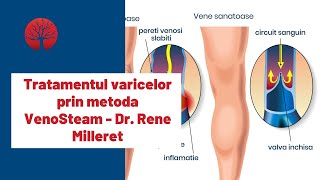 Dr Rene Milleret  Tratamentul varicelor prin metoda VenoSteam  Clinica VenArt [upl. by Kolb]