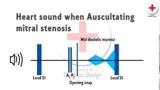 heart sound  Mitral stenosis [upl. by Gwennie]