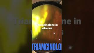 Triamcinolone in vitreous  IVTA [upl. by Aicilihp]