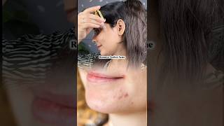 Shocking results remove acne amp acne marks in just 3 weeks skin acnetreatment [upl. by Lukash]