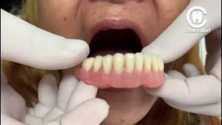 DENTAL PROSTHESIS without ACRYLIC on the LIP 😱😱😱 [upl. by Ailssa]