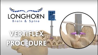 Longhorn Brain and Spine  Vertiflex Procedure [upl. by Gris]