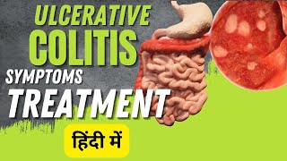 Ulcerative colitis symptoms and treatment  Inflammatory bowel disease [upl. by Dlnaod]