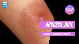 Abscess Carbuncle Boil Furuncle amp Cellulitis [upl. by Lai]