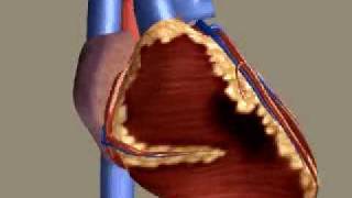 Myocardial Infarction [upl. by Jeff]