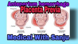 APHPlacenta PreviaMedical With Sanju [upl. by Kcirdde]