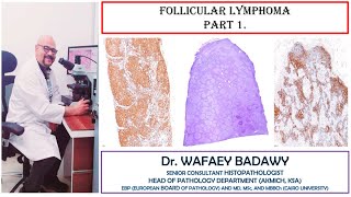 FOLLICULAR LYMPHOMA PART1 BY DR WAFAEY BADAWY [upl. by Iamhaj]