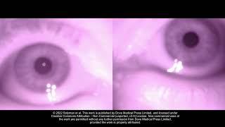 Smartphone Infrared Pupillography and Pupillometry  Supplementary video 2 ID 331989 [upl. by Malchus774]