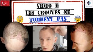 Mes croûtes ne tombent pas  Ma greffe de cheveux FUE 11 [upl. by Emelyne]