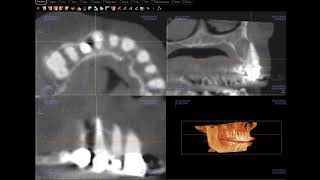 Periapical cyst radicular cyst confirmed [upl. by Brigette]