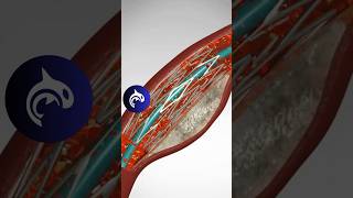 See how an Angioplasty and Stent Placement work in 3D animation [upl. by Pollock]