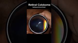 Retinal Coloboma Clinical View Captured with 20D Indirect Lens [upl. by Ecille]