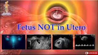 Fetus NOT in Utero [upl. by Cristabel]