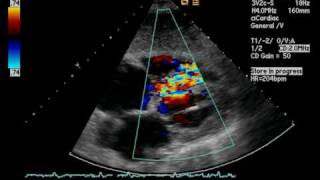 Septal Pseudoaneurysm Post MI [upl. by Mirabella816]