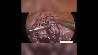 laparoscopic MYOMECTOMY [upl. by Carey]