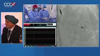 Live Case 1  Impella Supported PCI of Calcified LAD using Rotational Atherectomy and OCT Guidance [upl. by Aseneg]